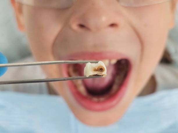 Best Emergency Wisdom Tooth Extraction in Lakeside, OR